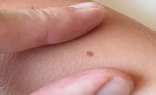 Завтра в Запоріжжі всі бажаючі можуть безкоштовно обстежитися на наявність злоякісних пухлин шкіри