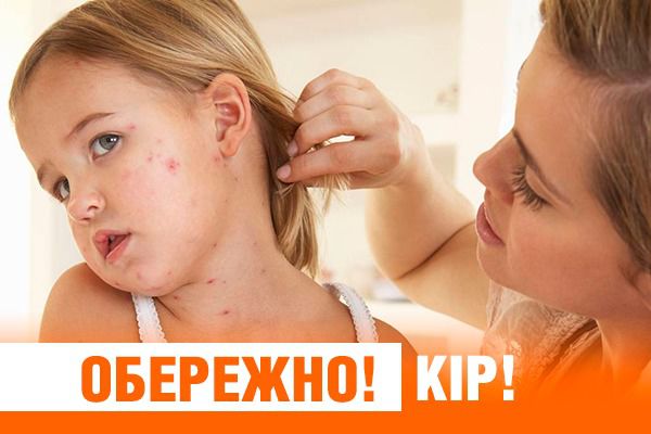 Захворювання на  кір найбільше розповсюджується серед малечі 